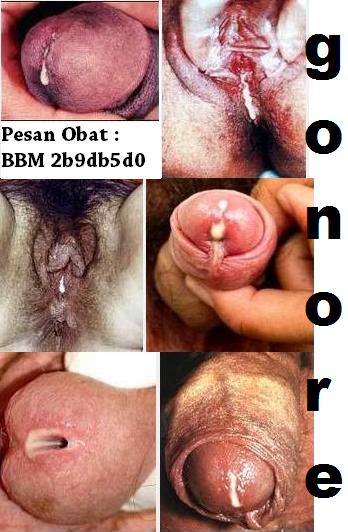 Cara Pengobatan Dalam 3-6 Hari Penyakit Kencing Nanah Pada Pria Cara Pengobatan Dalam 3-6 Hari Penyakit Kencing Nanah Pada Pria