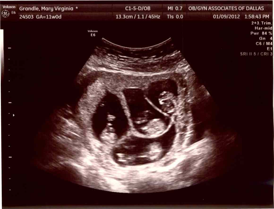 14 недель отзывы. 14 Недель размер ребенка. УЗИ 14 недель беременности.