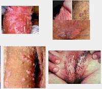 Obat Kutil Pada Kelamin Yang Ampuh Di Apotik Kimia Farma Terdekat Obat Kutil Pada Kelamin Yang Ampuh Di Apotik Kimia Farma Terdekat