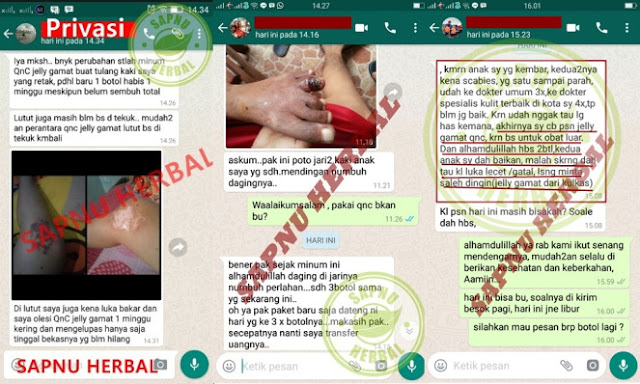 Cara Menghilangkan Bekas Luka Menahun, Terbukti Ampuh Dan Cepat Cara Menghilangkan Bekas Luka Menahun