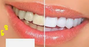 Cara Sehat Menghilangkan Kuning Pada Gigi