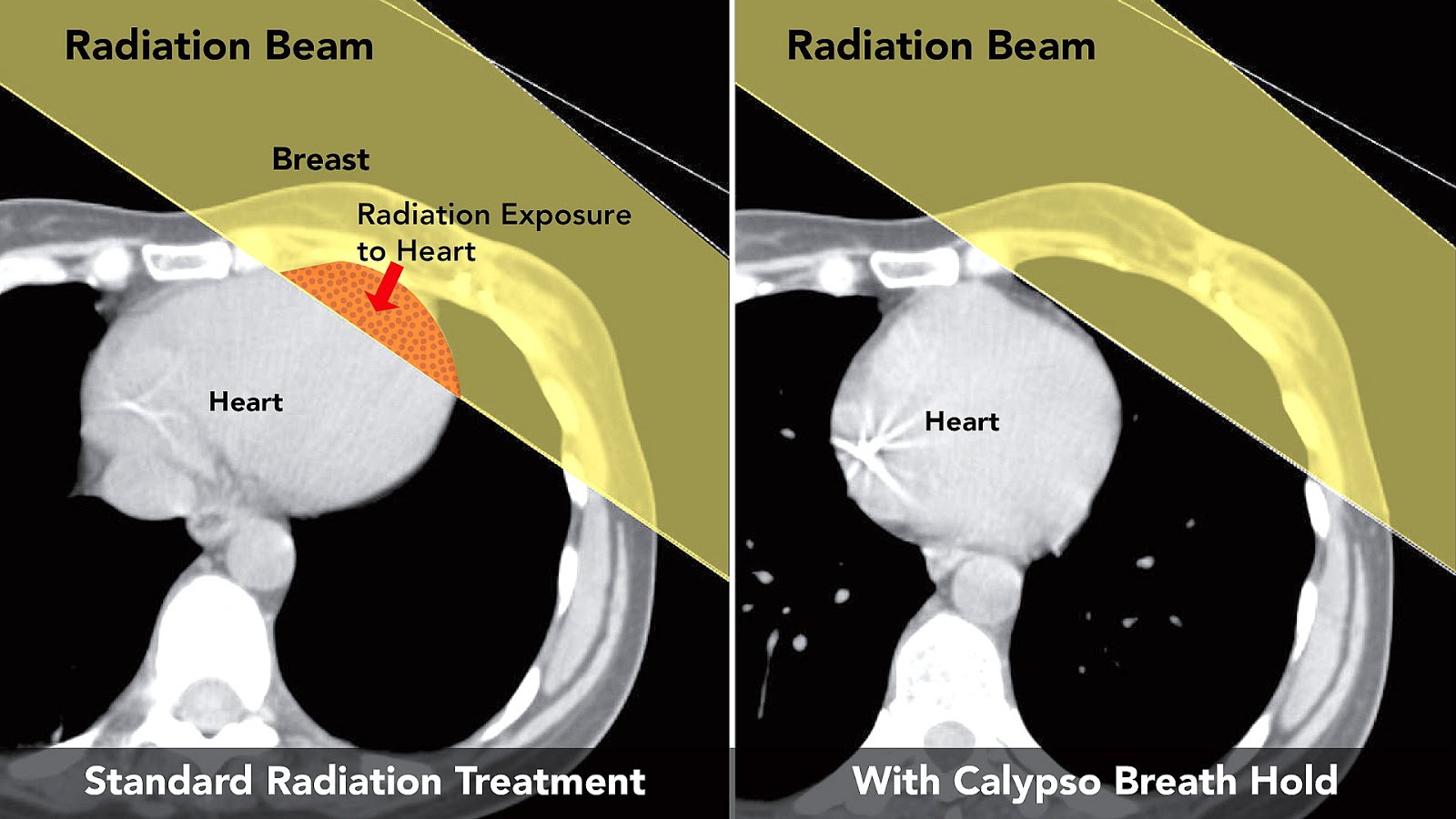 Radiation Therapy Breast Cancer Side Effects Effect Choices