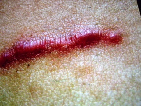 Cicatriz Cicatriz
