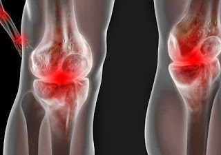 Berikut Tips Ampuh Mencegah Supaya Rematik Tidak Kambuh Berikut Tips Ampuh Mencegah Supaya Rematik Tidak Kambuh