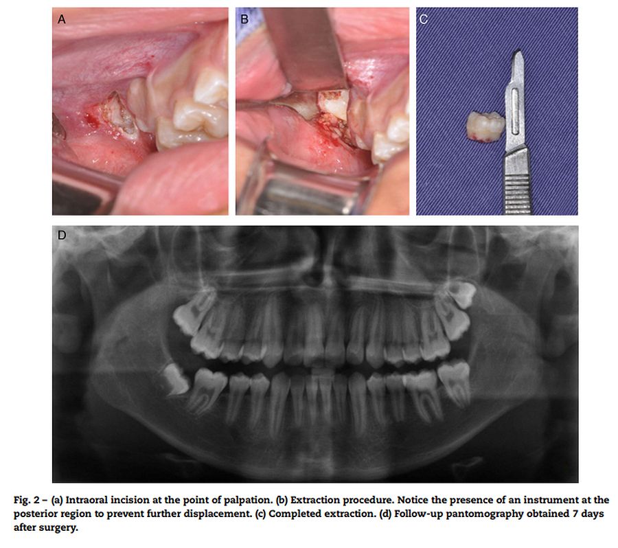 PDF Delayed removal of maxillary third molar displaced into the