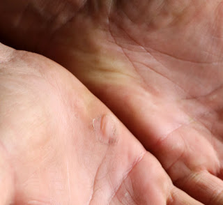 Blisters on old blisters Blisters on old blisters