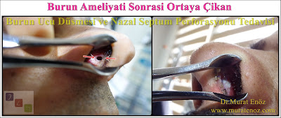 Nasal septal perforation - Repair of nasal septal perforation - Nasal septum perforation - Septal perforation - Surgical treatment of nasal septal perforation - Septal perforation repair surgery in Istanbul - Perforated septum treatment in Turkey
