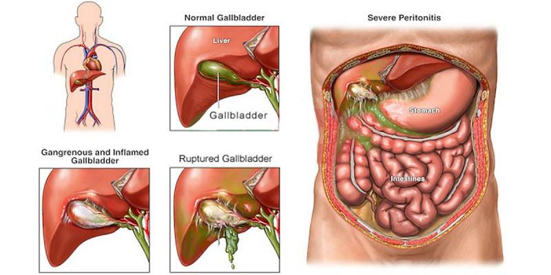 Dieta vesicula depois cirurgia