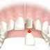Nên làm cầu răng sứ hay trồng răng implant?