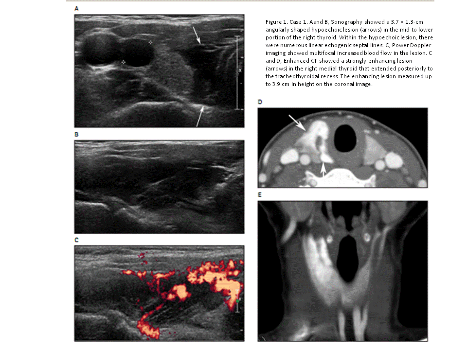BÀI SOẠN VỀ SIÊU ÂM CHẨN ĐOÁN THYROID HEMANGIOMA