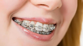 Sức khỏe, đời sống: Niềng răng mất bao lâu Nieng%2Brang