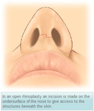 Nasal Rhinotomy Website material: Rhinoplasty