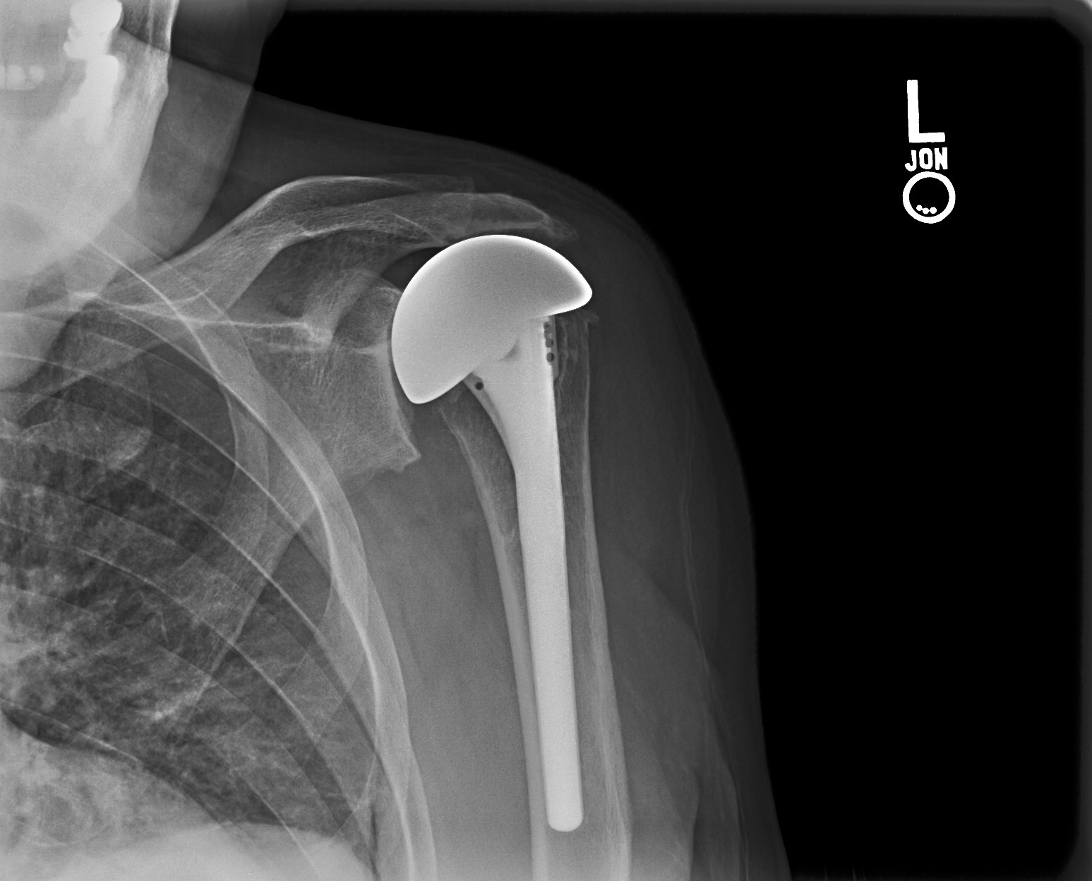 UW Shoulder and Elbow Academy Rotator cuff tear arthropathy and the CTA prosthesis