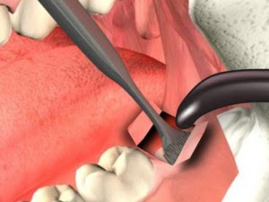 Nhổ răng cấm có đau không?