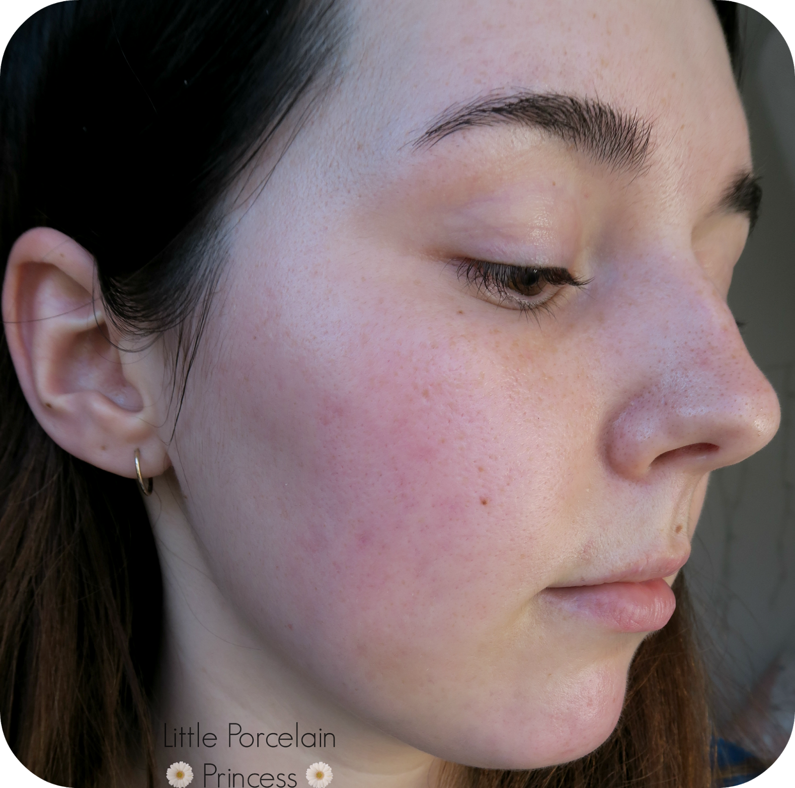 vitamin c serum burns my face