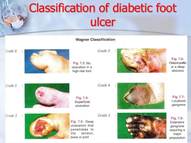 PDF Diabetic Foot Sepsis