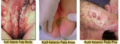 jamur kutil kelamin jamur kutil kelamin