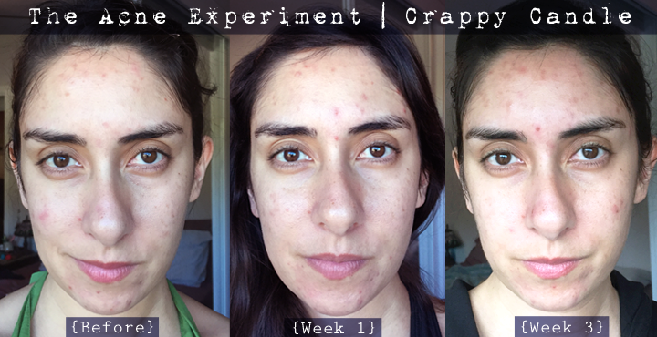 Before & After Paula's Choice Clear Regular Strength Anti-Redness Exfoliation Solution (2% Salicylic Acid)