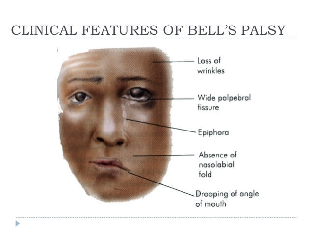 Bells-palsy