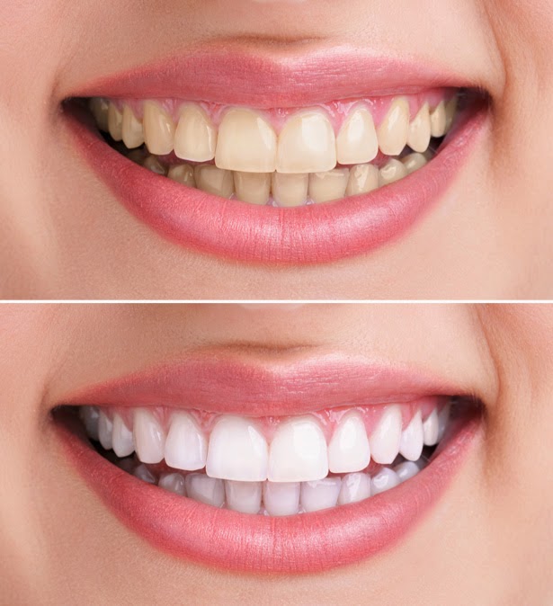 Pink-Adore: Dientes de photoshop y sonrisa de anuncio