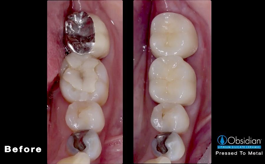 PFM CROWNS Traditional PFM Alternative & Impression Tray Selection