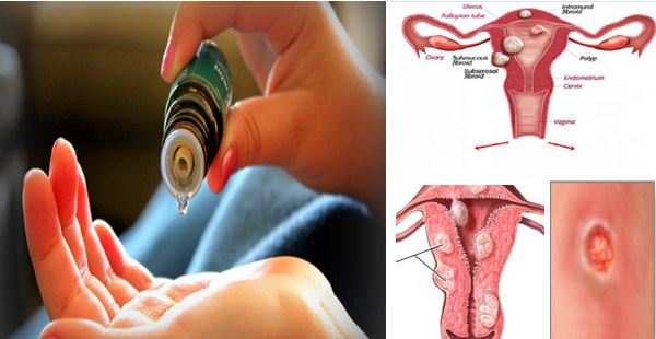 How to avoid ovarian cyst? How to avoid ovarian cyst?