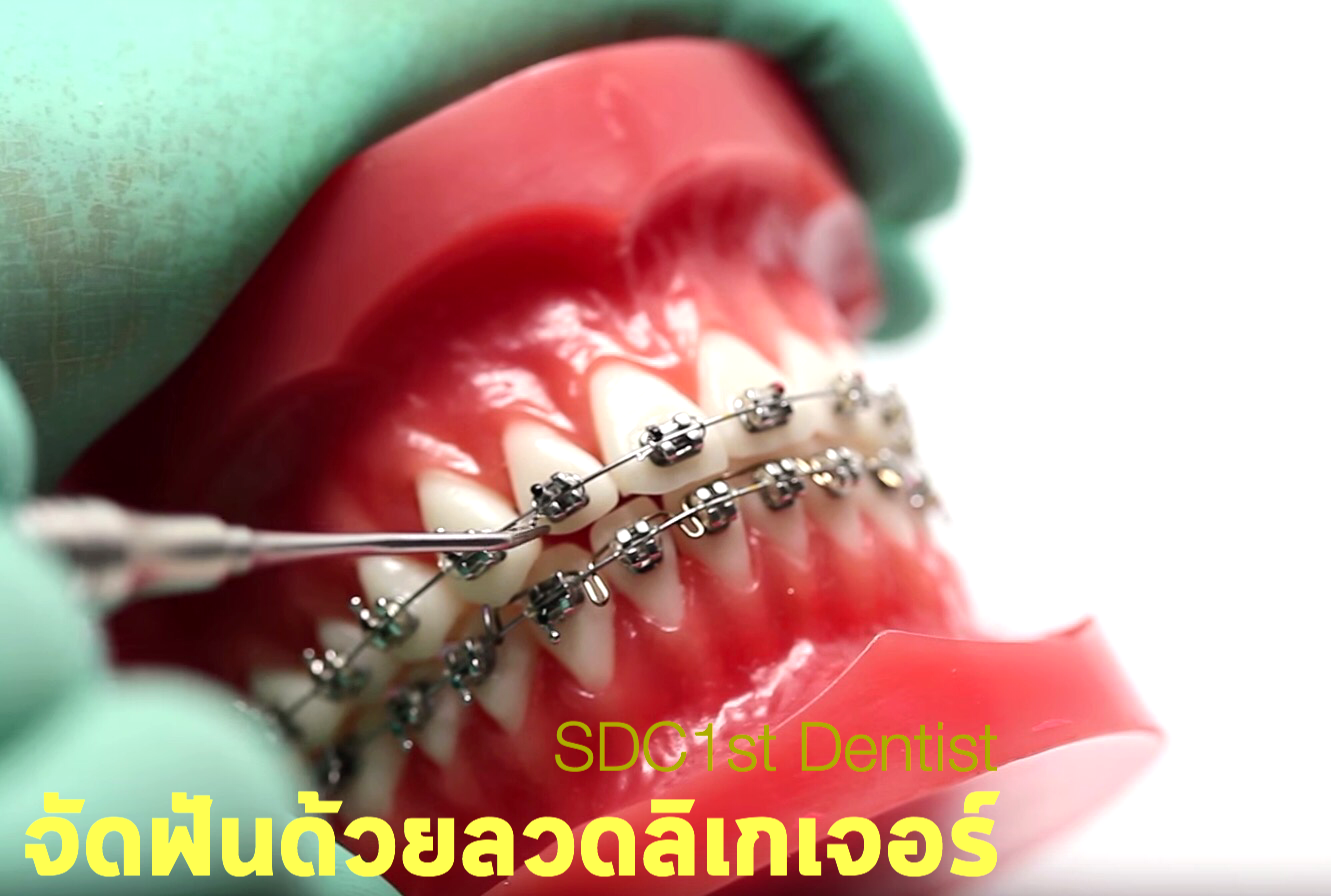 จัดฟัน ดัดฟัน: จัดฟันด้วยลวดลิเกเจอร์ (Ligature Braces)