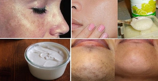 Get Ride Of Brown Spots With These incredible Natural Remedies