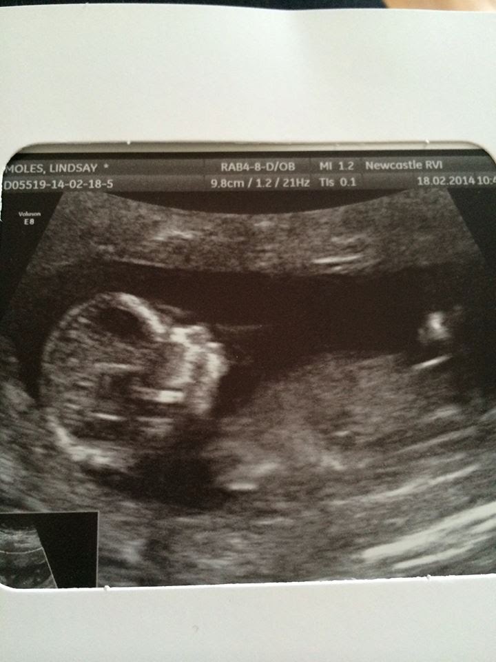 13 week baby scan 