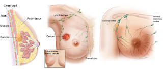 obat kanker payudara,