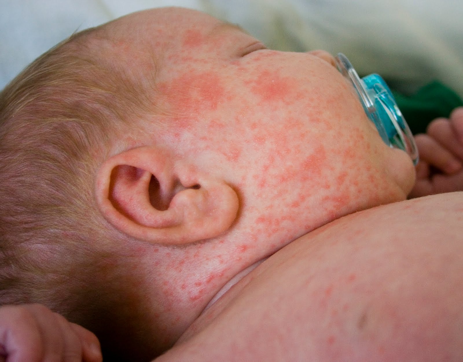 Erythema toxicum (newborn rash) | BabyCenter