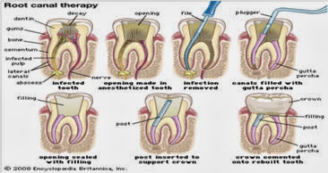 Dental Encyclopedia: ROOT CANAL TREATMENT (RCT)