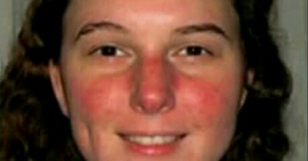 Папулопустулярная розацеа. Девушка краснеет. Почему у девочек краснеет. Розовые щеки. Почему у девочек краснеет.