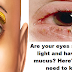 Are your eyes sensitive to light and have stringy mucus? Here's what you need to know!