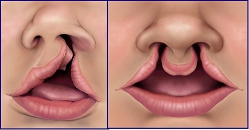 CHỈ ĐỊNH CẤY IMPLANT VÀ CHỐNG CHỈ ĐỊNH CẤY IMPLANT