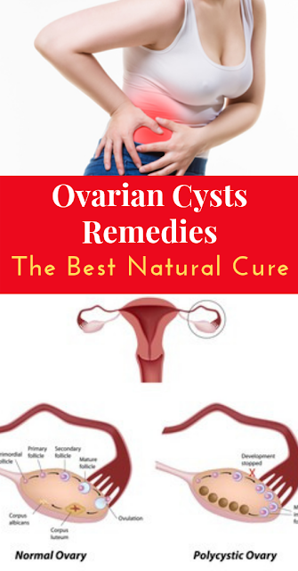 How To Cure Ovarian Cysts