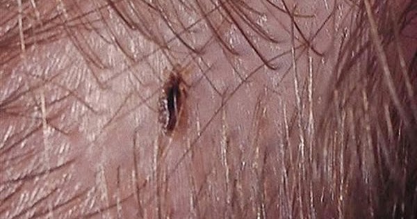 How Long Can Head Lice Live On Bedding How Long Can Head Lice Live On Bedding