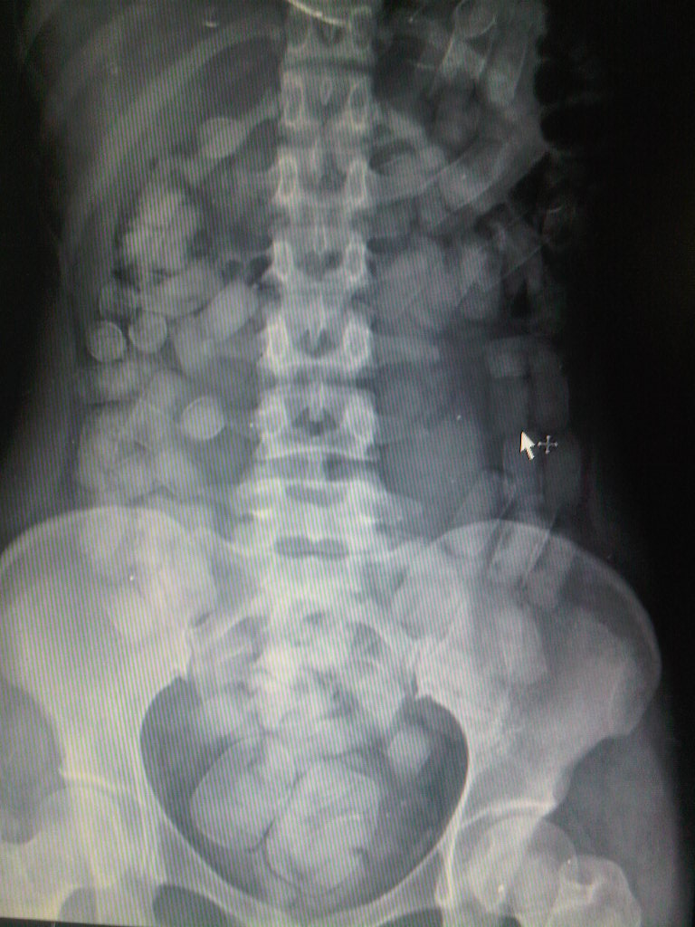 Medicina de Emergencias Panamá Body Packer Admitida a Observación