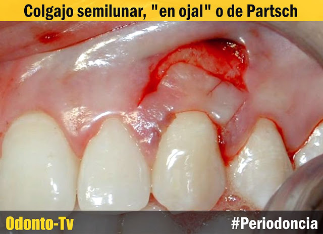 Periodontal plastica que la cirugia es