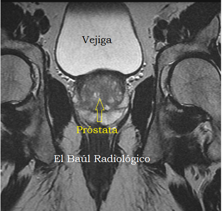 resonancia magnética de próstata cómo hacerlos