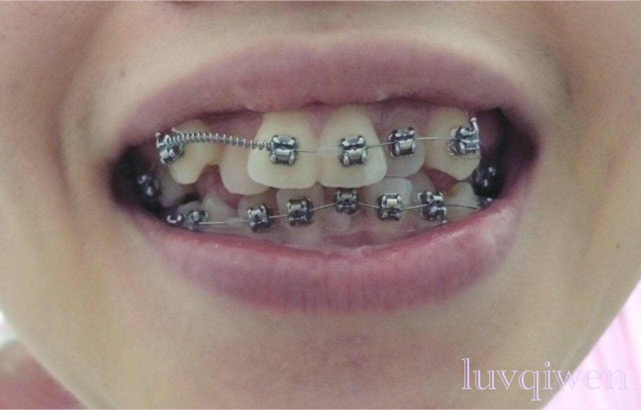 End of braces wire catching : r/braces