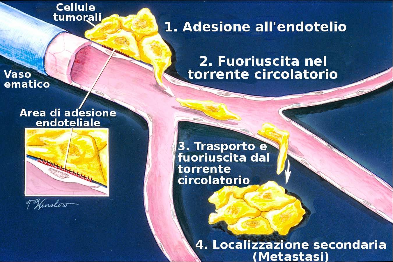 metastatica_per_via_ematica