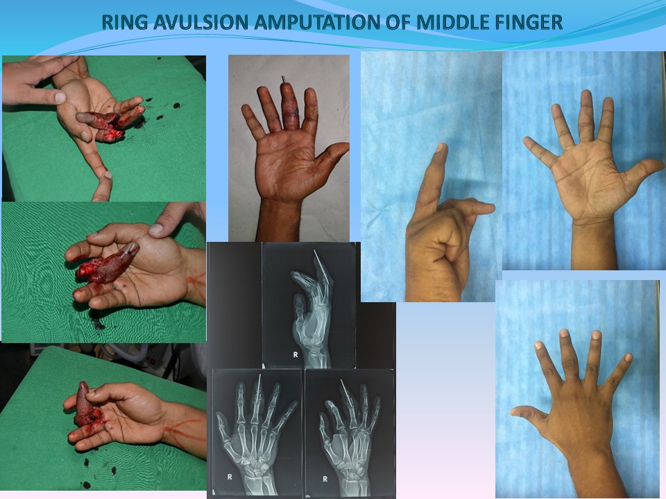 Mallet Finger - Hand - Orthobullets