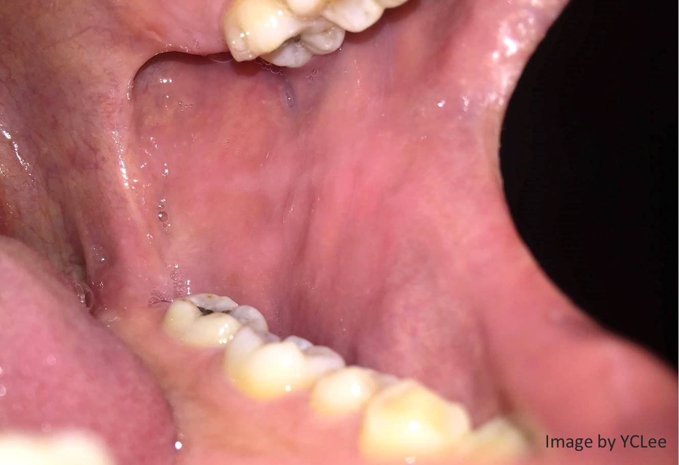 エナメル上皮線維腫 | 口腔病理基本画像アトラス