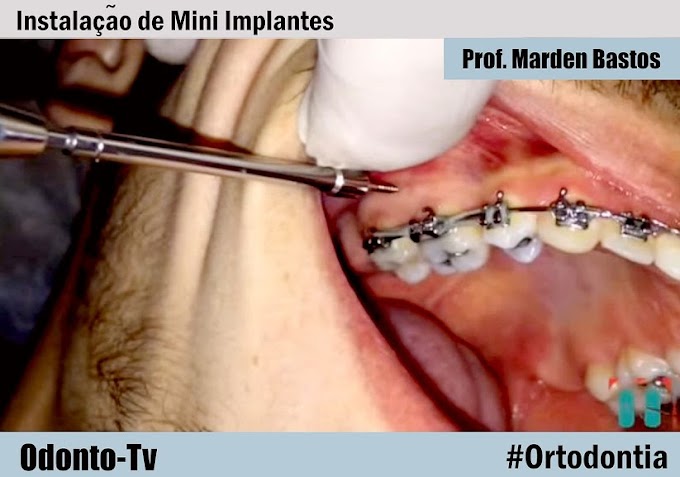 ORTODONTIA: Instalação de Mini Implantes - Prof. Marden Bastos