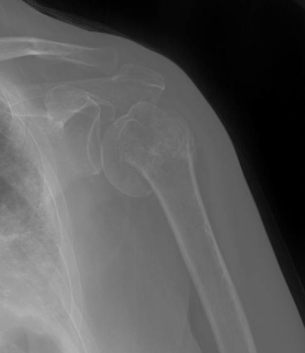 Shoulder and Elbow Surgery Shoulder subluxation after proximal humerus