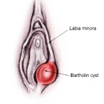 Tentang Kisata Bartholin Tentang Kisata Bartholin