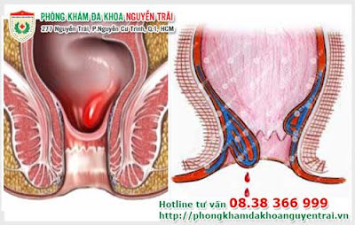 mac-phai-benh-tri-do-nguyen-nhan-gi-1 mac-phai-benh-tri-do-nguyen-nhan-gi-1