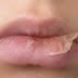 5 Kesalahan Cara Mengatasi Bibir Kering dan Mengelupas