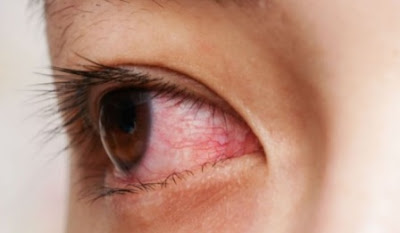Red Eye Causes, Bloodshot Eyes Dangerous Or Not